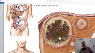 Hepatic Surgery 12  Amoebic liver abscess   by Dr Wahdan [upl. by Livesay]