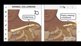 CLEIDOCRANIAL DYSPLASIA  IN JUST 5 MINUTES  SIMPLE AND EASY [upl. by Ojytteb]