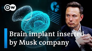 Elon Musks startup Neuralink implants first chip in human brain  DW News [upl. by Nairadal]