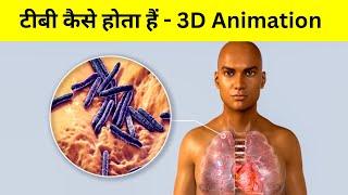 ट्यूबरकुलोसिस TB कैसे होता हैं  tuberculosis etiology amp pathophysiology [upl. by Stoat]