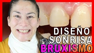 👉Reconstrucción DIENTES DESGASTADOS POR BRUXISMO👈 Antes y Después de BEATRIZ  DISEÑO DE SONRISA [upl. by Eessac]