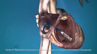 The Medtronic Micra—the Worlds Smallest Pacemaker Is Implanted in the Heart [upl. by Eilrahc]