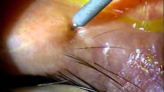 Dry Eye Syndrome Silicon Punctal Plug insertion [upl. by Odlabso]