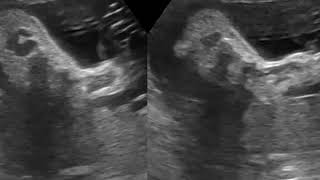 CASE 503 4D US fetal skeletal rhizomesomelic dysplasia osteogenesis imperfecta [upl. by Kehoe683]