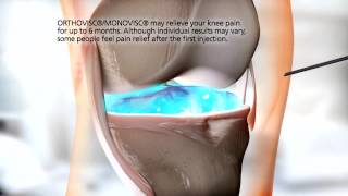 ORTHOVISC®MONOVISC® Injection Animation [upl. by Vin]