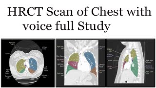 HRCT scan of Chest full study [upl. by Appledorf]