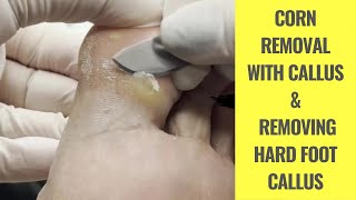 Corn Removal with Callus  Removing Hard Foot Callus  Foot Care Callus Podiatry [upl. by Ackerley357]