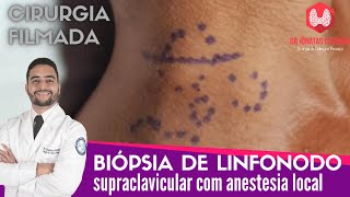 Biopsia de linfonodo supraclavicular com anestesia local  Cirurgia completa [upl. by Us781]