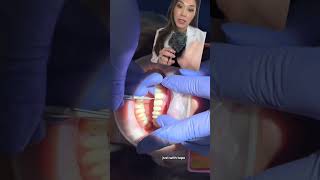 Changing composite veneers to porcelain veneers compositeveneers porcelainveneers smilemakeover [upl. by Hester]