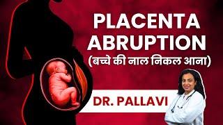 Placenta Abruption Causes Symptoms Diagnosis amp Treatment  Explained in Hindi  Abruptio Placentae [upl. by Nuahsyar364]