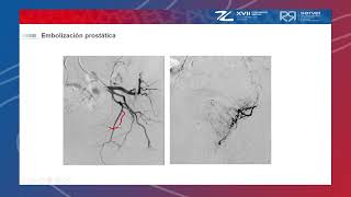 Embolización de próstata  Dr Íñigo Insausti  Congreso SERVEI 2021 [upl. by Adnuahsar]