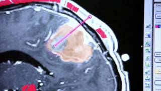 Brainlab Software Helps Deliver Better Chemotherapy Therapy to Patients [upl. by Ahsinek]