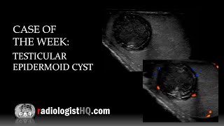 Case of the Week Testicular Epidermoid Cyst Ultrasound [upl. by Enawd]