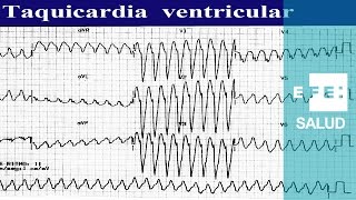 Taquicardia Ventrículos a 200 mortíferos latidos [upl. by Ing216]