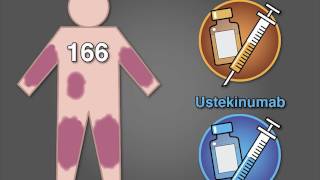 Risankizumab vs Ustekinumab for Psoriasis [upl. by Socin27]