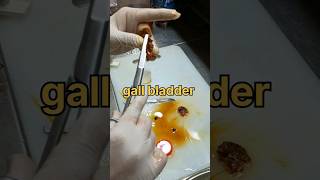 Gall bladder specimen grossing பித்தப்பை  tissuefixation gallstones gallstonessymptoms [upl. by Bevis]