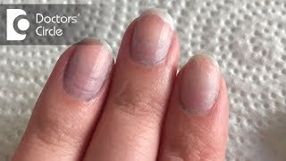 What causes bluish discoloration of nail beds  Dr Rashmi Ravindra [upl. by Gaultiero]