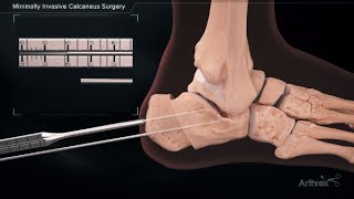 Minimally Invasive Calcaneus Surgery [upl. by Eiramyma]