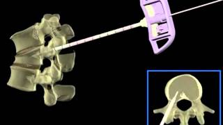 Cifoplastia com Balão Kyphon  Transpedicular [upl. by Aiset970]