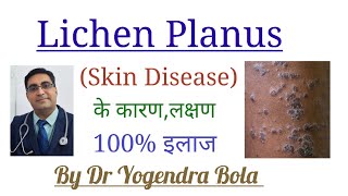 Lichen Planus  Skin Disease  के कारण लक्षण और 100 इलाज  By Dr Yogendra Bola [upl. by Nevet]