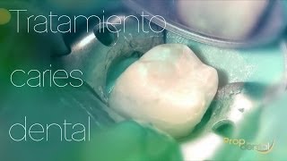 Tratamiento caries dental [upl. by Rehpinej]