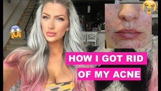 👏🏻 HOW I GOT RID OF MY ACNE 👋🏻 BroadBand Light laser [upl. by Canter]