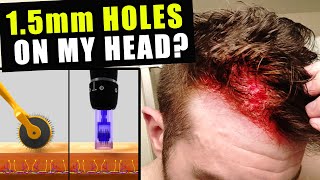 I Cut Thousands Of 15 Millimetre Holes In My Head Every Week To Prevent Hair Loss [upl. by Kanor173]