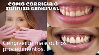 Tratamento para o Sorriso Gengival Gengivectomia Gengivoplastia Aumento de Coroa Clínica Botox [upl. by Lot]