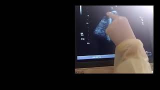 All sonographic findings of lung US in LT lung of one patient [upl. by Sinnek]