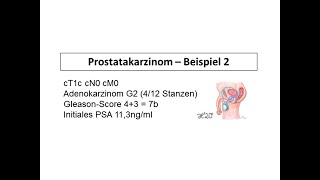 Beispiel 1 für die Behandlung eines Prostatakarzinoms  Strahlentherapie Prof Hilke Vorwerk [upl. by Adalia]