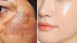 In 2 DAYSRemove DARK SPOTS  Apply Treatment on Your DARK SPOTS and See the Magic [upl. by Occer374]