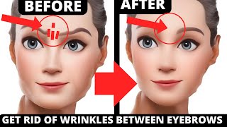 GET RID OF FROWN LINES NATURALLY  NO BOTOX  FACE EXERCISE [upl. by Vigen]