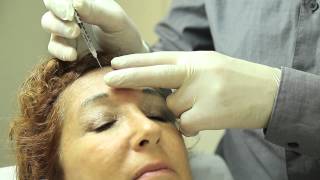 Injections de Botox ou toxine botulique  Technique et résultats [upl. by Dougald]