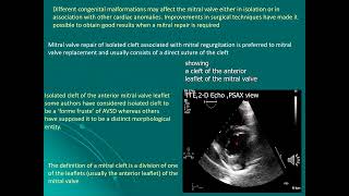 1 Test your skill congenital defect endocardial cushion defect [upl. by Ramat]