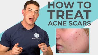 What do Experts Recommend for Acne Scars  208SkinDoc [upl. by Sheppard]