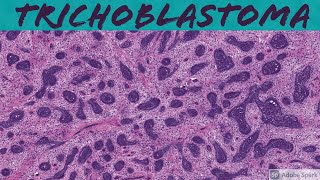 Trichoblastoma 5Minute Pathology Pearls [upl. by Girish]