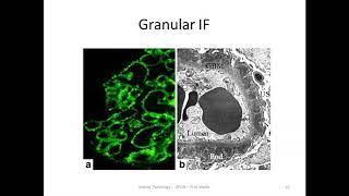 Rapidly Progressive Glomerulonephritis Renal Pathology Prof Wadie [upl. by Constantino]