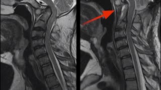 Case Report Endoscopic Transcervical Odontoidectomy for Basilar Impression [upl. by Ugo]