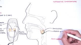 Strep throat streptococcal pharyngitis pathophysciology signs and symptoms diagnosis treatment [upl. by Andrew]