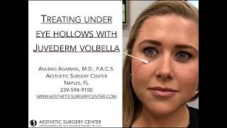 Treating Under Eye Hollows with Juvederm Volbella by Dr Agarwal [upl. by Oznarol]