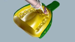 IMPLANTE DENTAL UNITARIO fase de prótesis [upl. by Murat]