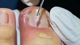 Removing Infected Ingrown Toenails [upl. by Nica962]