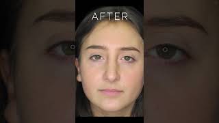 Before amp After Nose Job Surgery Dorsal Hump amp Ptotic Tip nosejobbeforeandafter [upl. by Flossi]