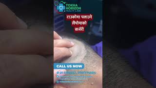 Subgaleal lipoma  dr bijay  tokha horizon [upl. by Constant]