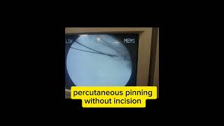 fracture metacarpalclose reduction percutaneous pinning [upl. by Brandea]