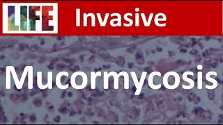 Mucormycosis [upl. by Walker254]