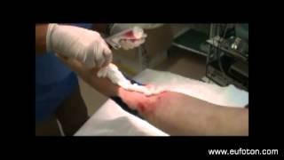 LASEmaR 800  Wound Healing Photobiomodulation and Debridement [upl. by Suneya]