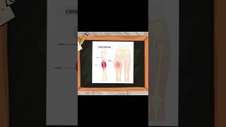 Ewing Sarcoma Common Locations ewingsarcoma ewing sarcoma ortholectures orthopaedics [upl. by Chariot896]