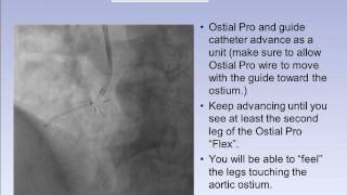 OstialPRO® Stent Positioning System RCA 2 [upl. by Beedon]