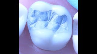 Class II Amalgam Restoration 1  Operative Dentistry [upl. by Jowett]